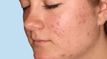 stress acne behandeling stress acne behandeling
